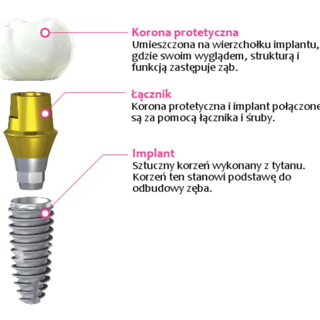 Implanty zębowe w Rudzie Śląskiej